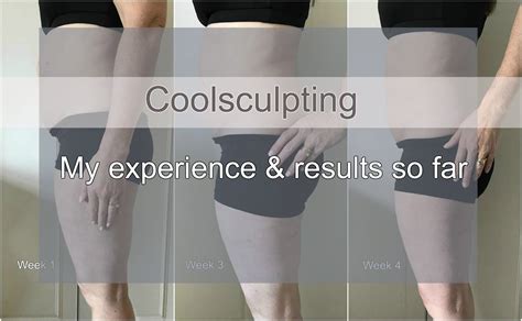 coolsculpting centennial|So Far, So Good .